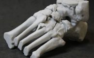 34.BI-MU - UNIPV, frattura tarso e metatarso